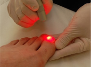 Laser Fungal Nail Treatment