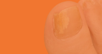 Laser Fungal Nail Therapy