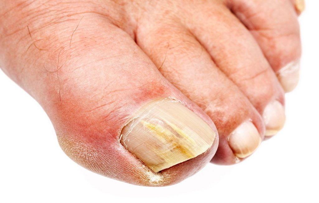 Toenail with fungal infection