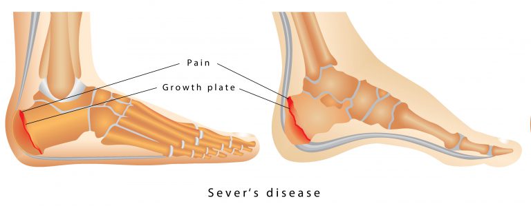 Severs in Children can be fixed by a Children's Podiatrist