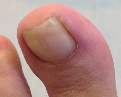 Ingrown Toenails can be painful and inflamed