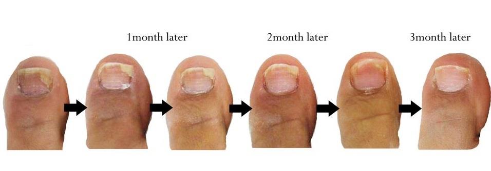 Best Nail Fungus Treatment