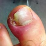 Ingrown Toenail