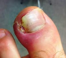 Ingrown Toenail Surgery