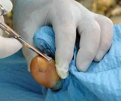 Ingrown Toenail treatment